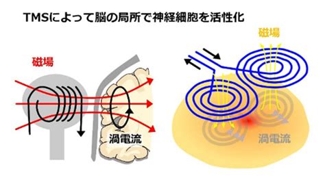 磁場 頭痛